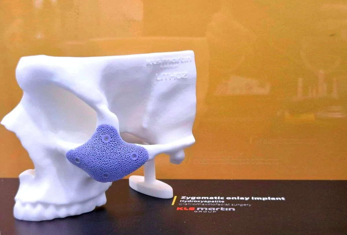 Макет имплантата скуловой кости, напечатанного на 3D-принтере, с сетчатой структурой.